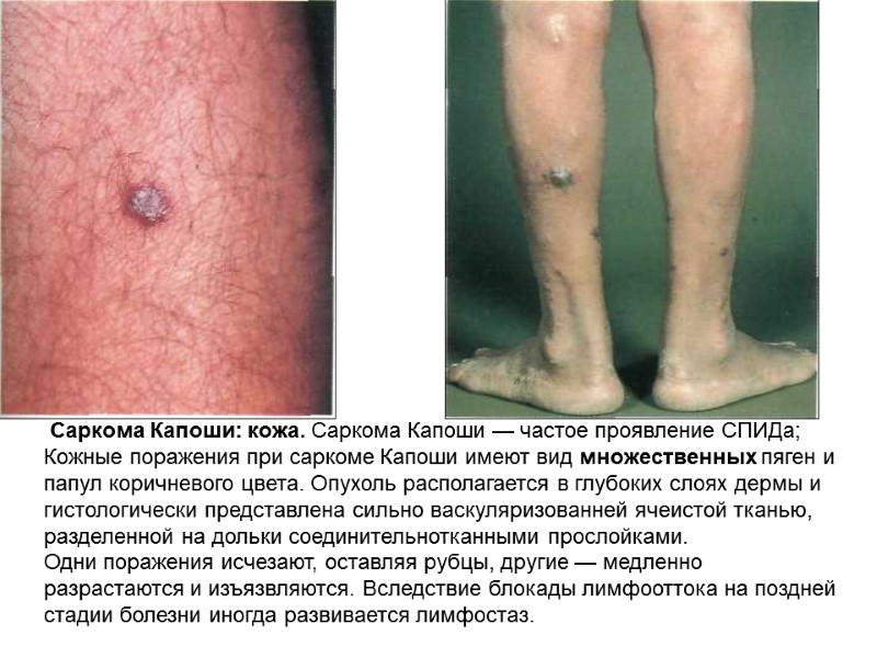 Саркома Капоши: кожа. Саркома Капоши — частое проявление СПИДа; Кожные поражения при саркоме Капоши